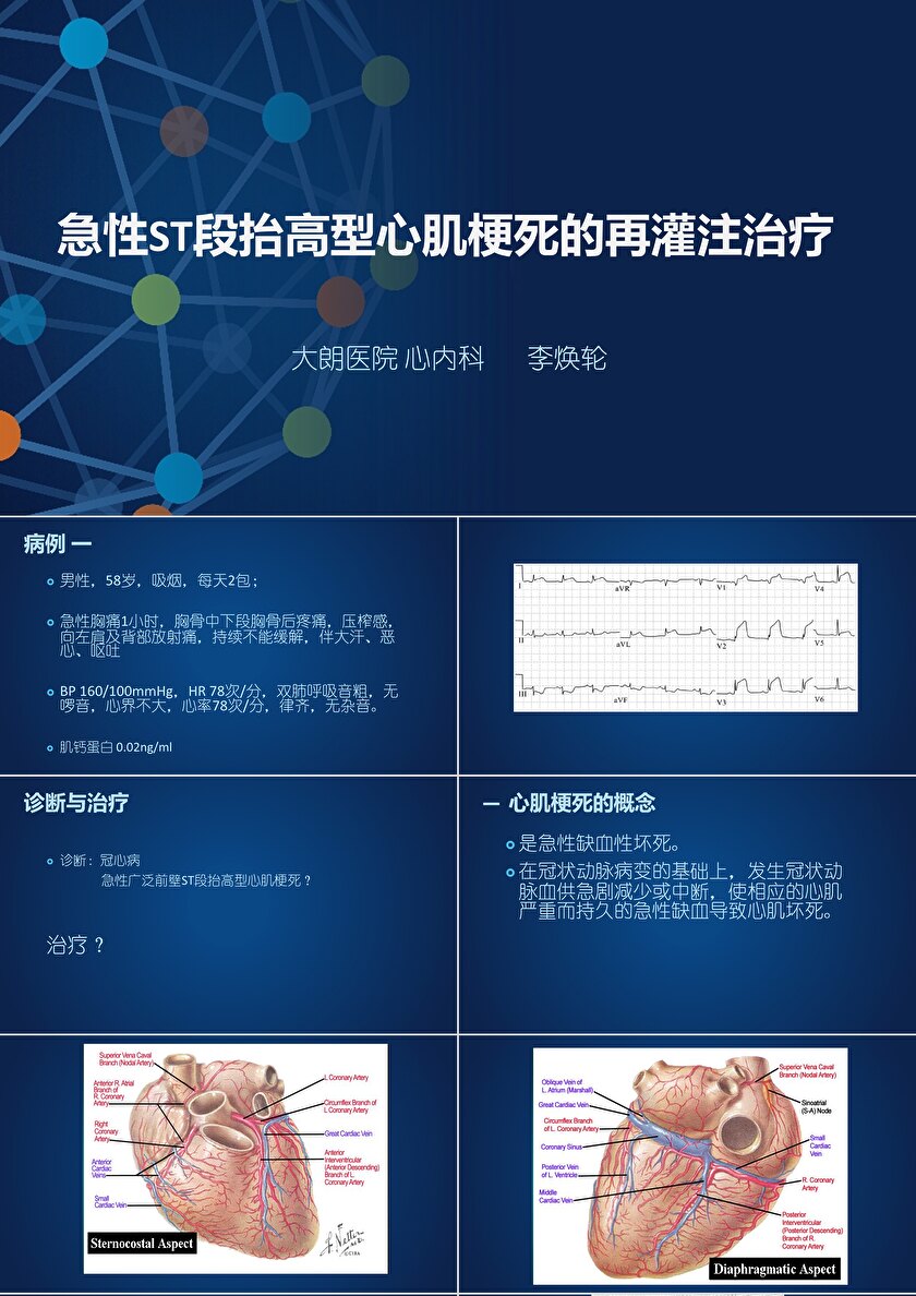 急性st段抬高型心肌梗死的再灌注治疗ppt模板卡卡办公 