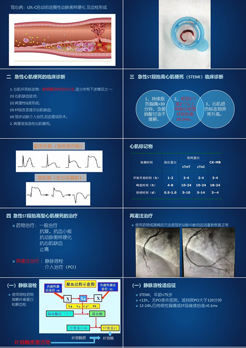 急性st段抬高型心肌梗死的再灌注治疗ppt模板卡卡办公 